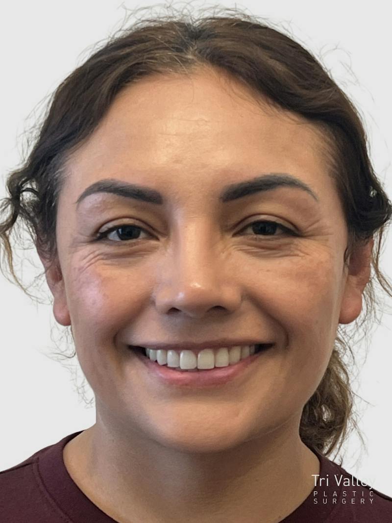 Rhinoplasty Before & After Gallery - Patient 278610 - Image 8