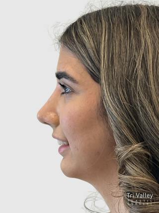 Rhinoplasty Before & After Gallery - Patient 372173 - Image 2