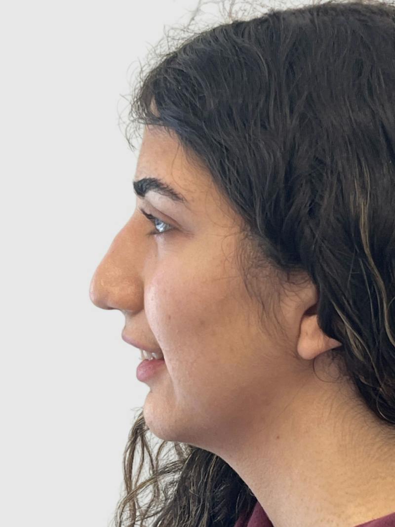 Rhinoplasty Before & After Gallery - Patient 372173 - Image 1