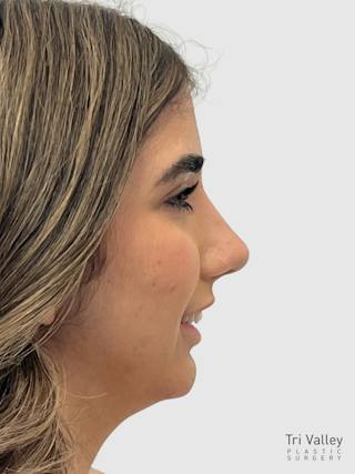 Rhinoplasty Before & After Gallery - Patient 372173 - Image 4
