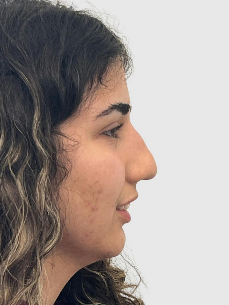 Rhinoplasty Before & After Gallery - Patient 372173 - Image 3
