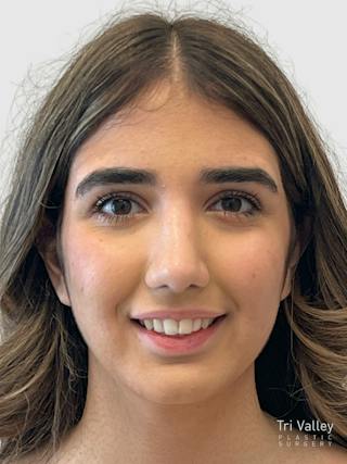Rhinoplasty Before & After Gallery - Patient 372173 - Image 6