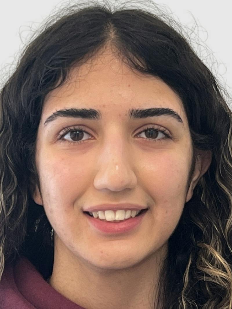 Rhinoplasty Before & After Gallery - Patient 372173 - Image 5