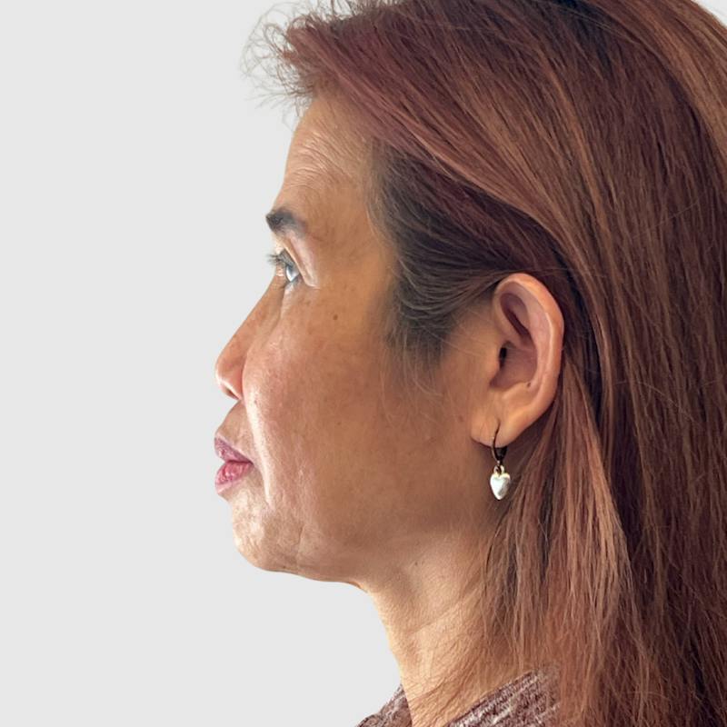Face and Neck Lifts Before & After Gallery - Patient 491759 - Image 5