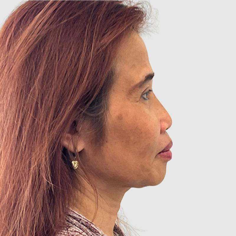 Face and Neck Lifts Before & After Gallery - Patient 491759 - Image 7