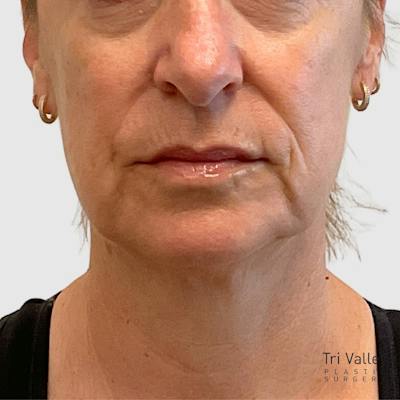 Laser Skin Resurfacing Before & After Gallery - Patient 776314 - Image 2