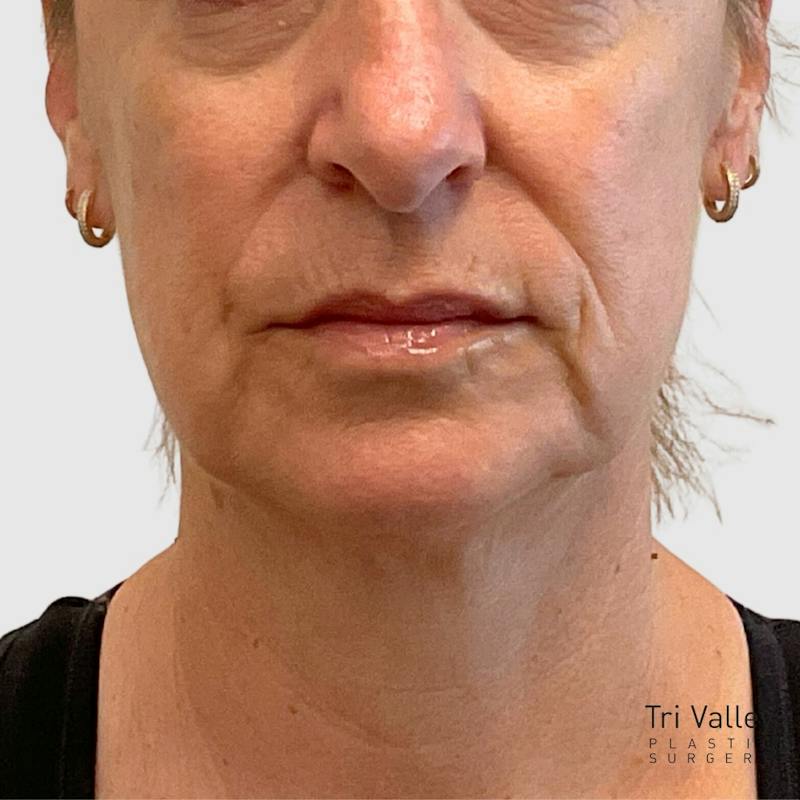 Laser Skin Resurfacing Before & After Gallery - Patient 776314 - Image 2