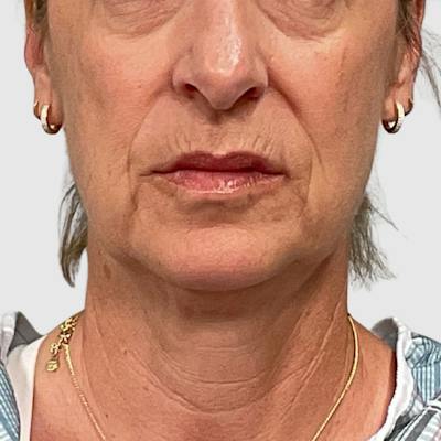 Laser Skin Resurfacing Before & After Gallery - Patient 776314 - Image 1