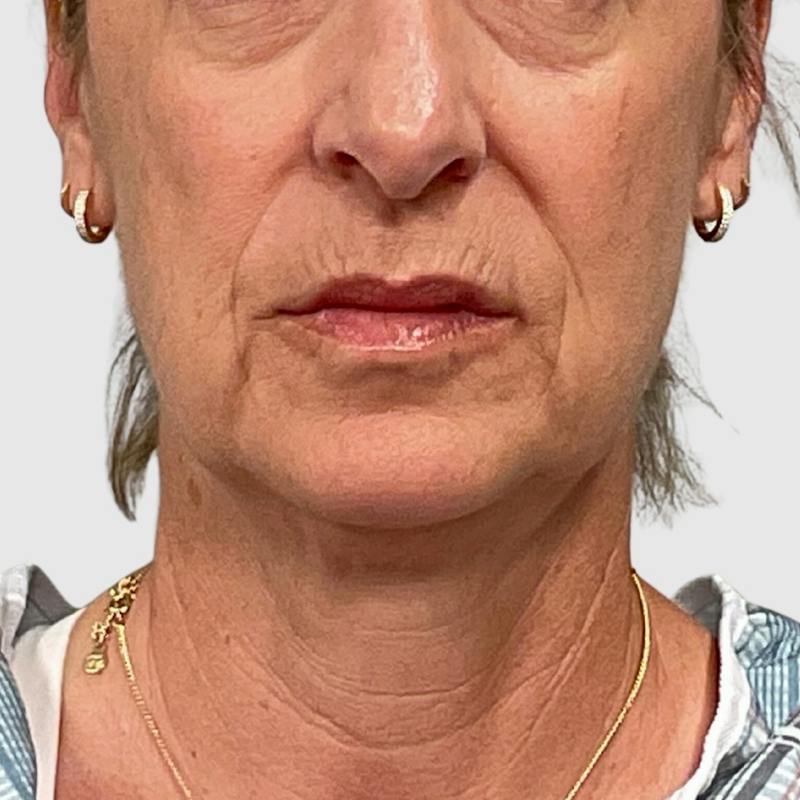 Laser Skin Resurfacing Before & After Gallery - Patient 776314 - Image 1