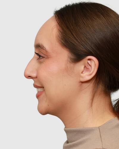Rhinoplasty Before & After Gallery - Patient 290603 - Image 1