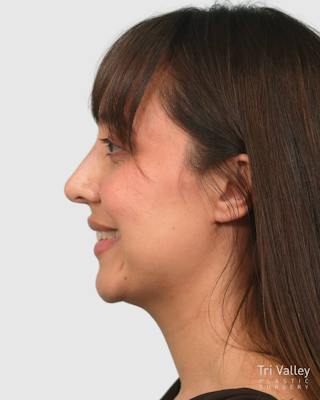 Rhinoplasty Before & After Gallery - Patient 290603 - Image 2