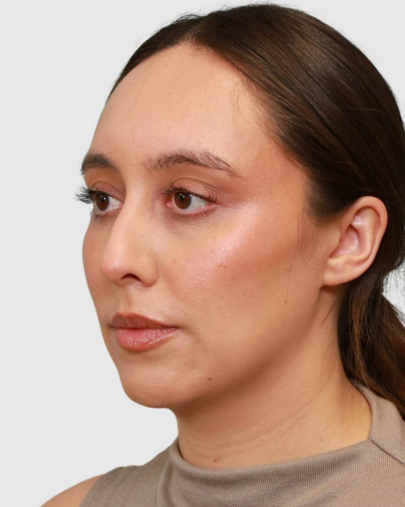 Rhinoplasty Before & After Gallery - Patient 290603 - Image 3