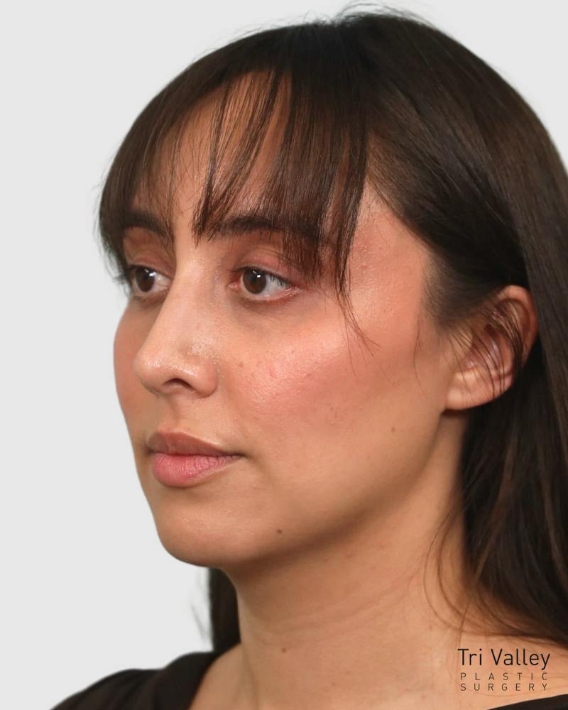 Rhinoplasty Before & After Gallery - Patient 290603 - Image 4