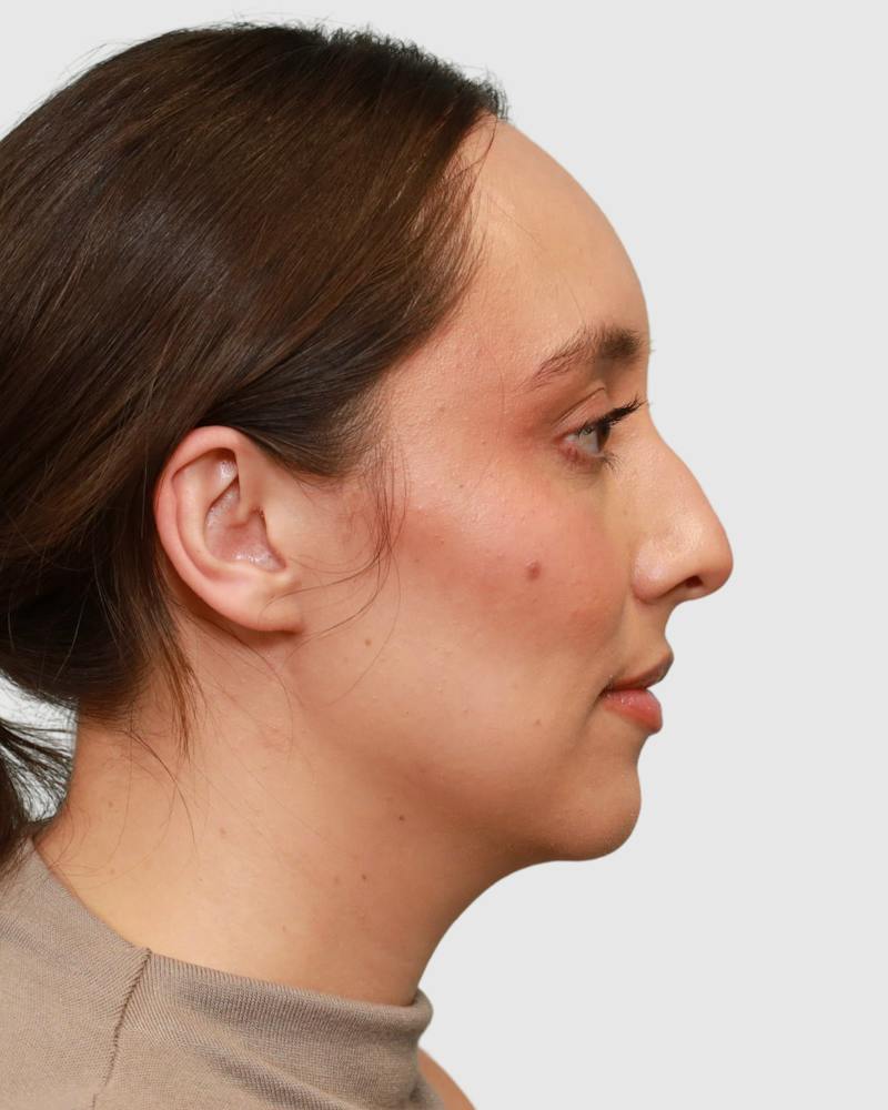 Rhinoplasty Before & After Gallery - Patient 290603 - Image 9