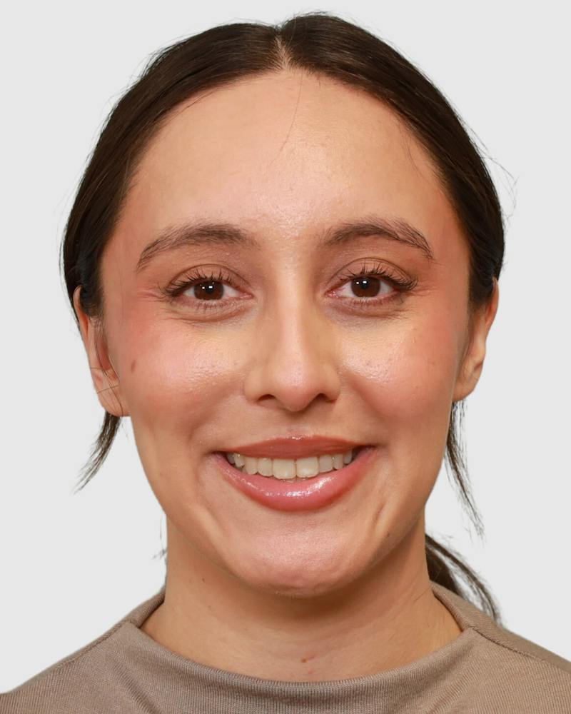 Rhinoplasty Before & After Gallery - Patient 290603 - Image 5