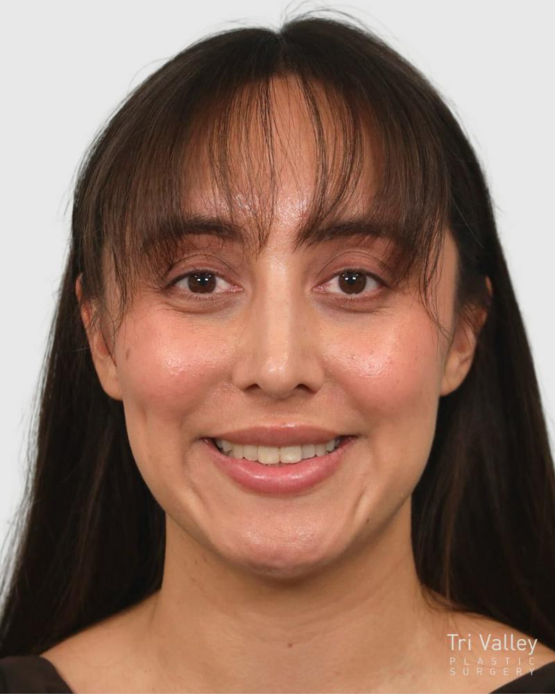Rhinoplasty Before & After Gallery - Patient 290603 - Image 6