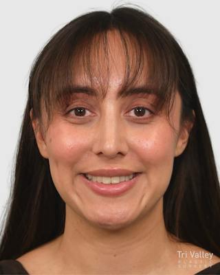 Rhinoplasty Before & After Gallery - Patient 290603 - Image 6