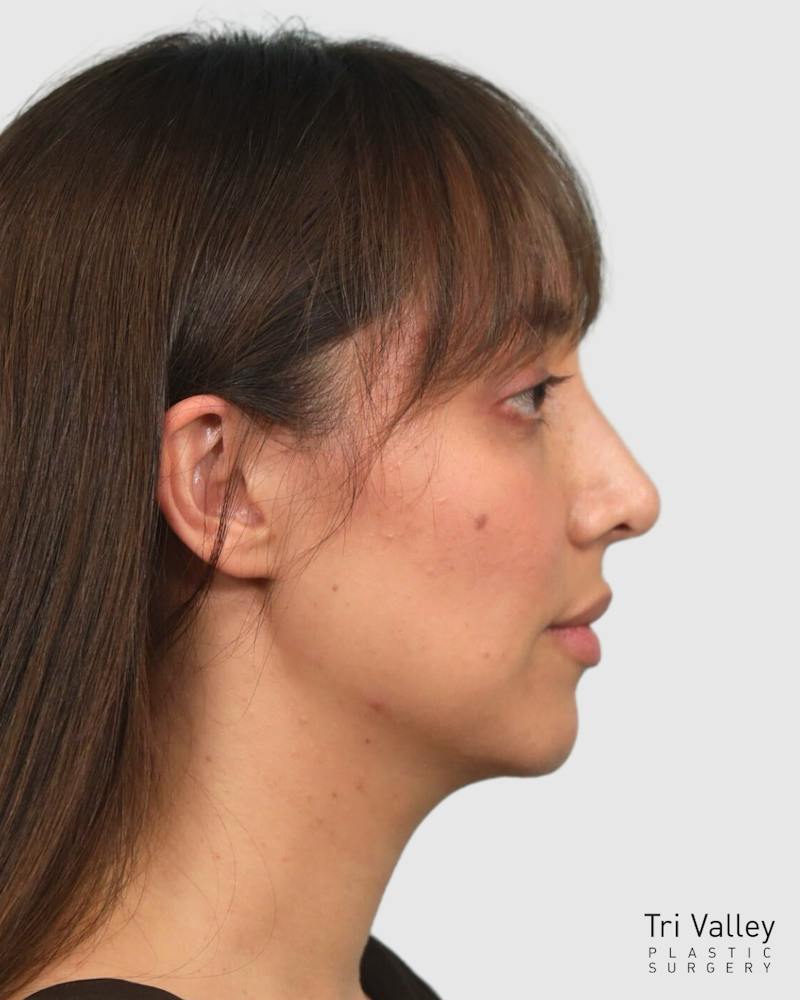 Rhinoplasty Before & After Gallery - Patient 290603 - Image 10