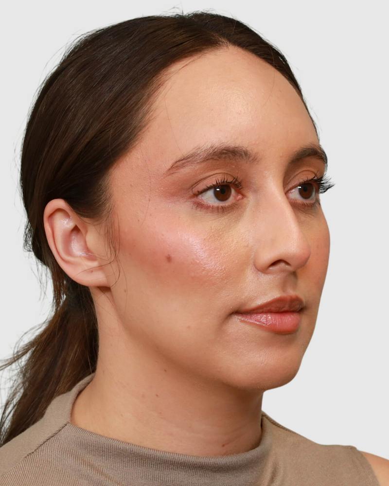 Rhinoplasty Before & After Gallery - Patient 290603 - Image 7
