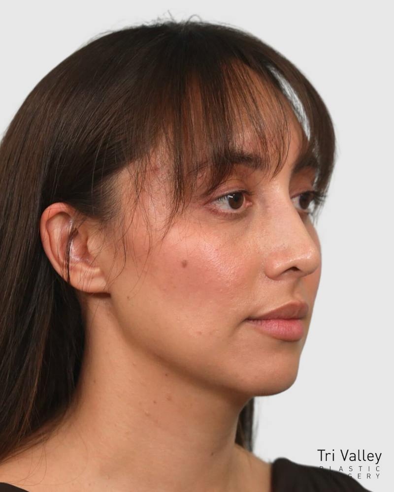 Rhinoplasty Before & After Gallery - Patient 290603 - Image 8