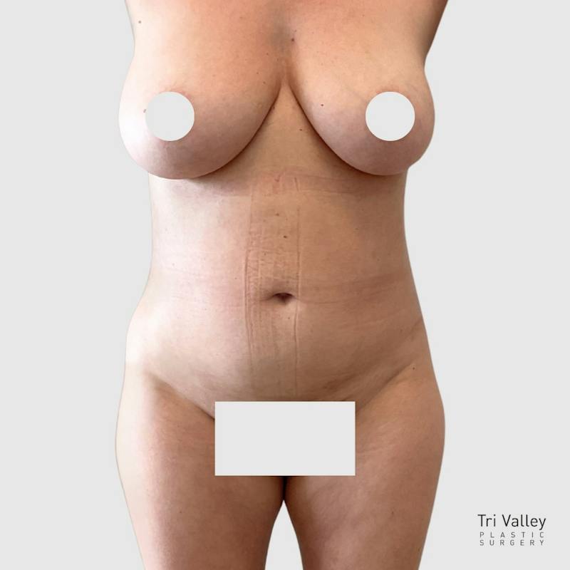 Liposuction Before & After Gallery - Patient 251233 - Image 2