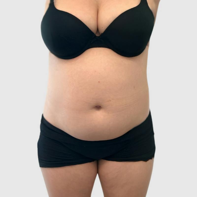 Liposuction Before & After Gallery - Patient 251233 - Image 1