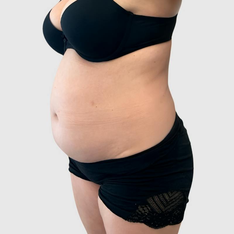 Liposuction Before & After Gallery - Patient 251233 - Image 3