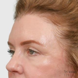 Blepharoplasty Before & After Gallery - Patient 117352 - Image 2