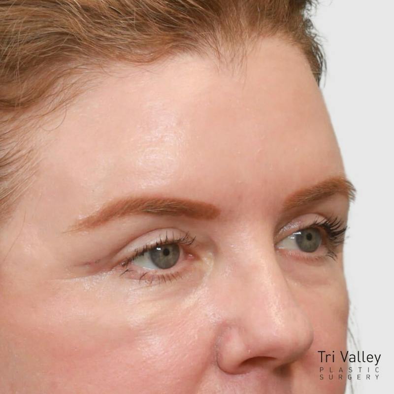 Blepharoplasty Before & After Gallery - Patient 117352 - Image 4