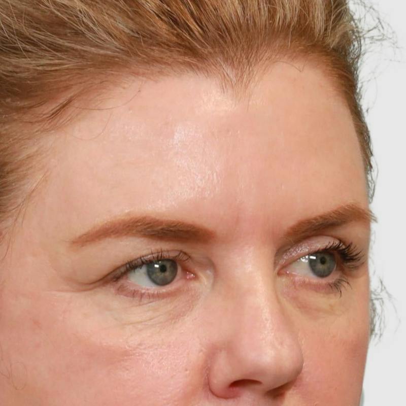 Blepharoplasty Before & After Gallery - Patient 117352 - Image 3