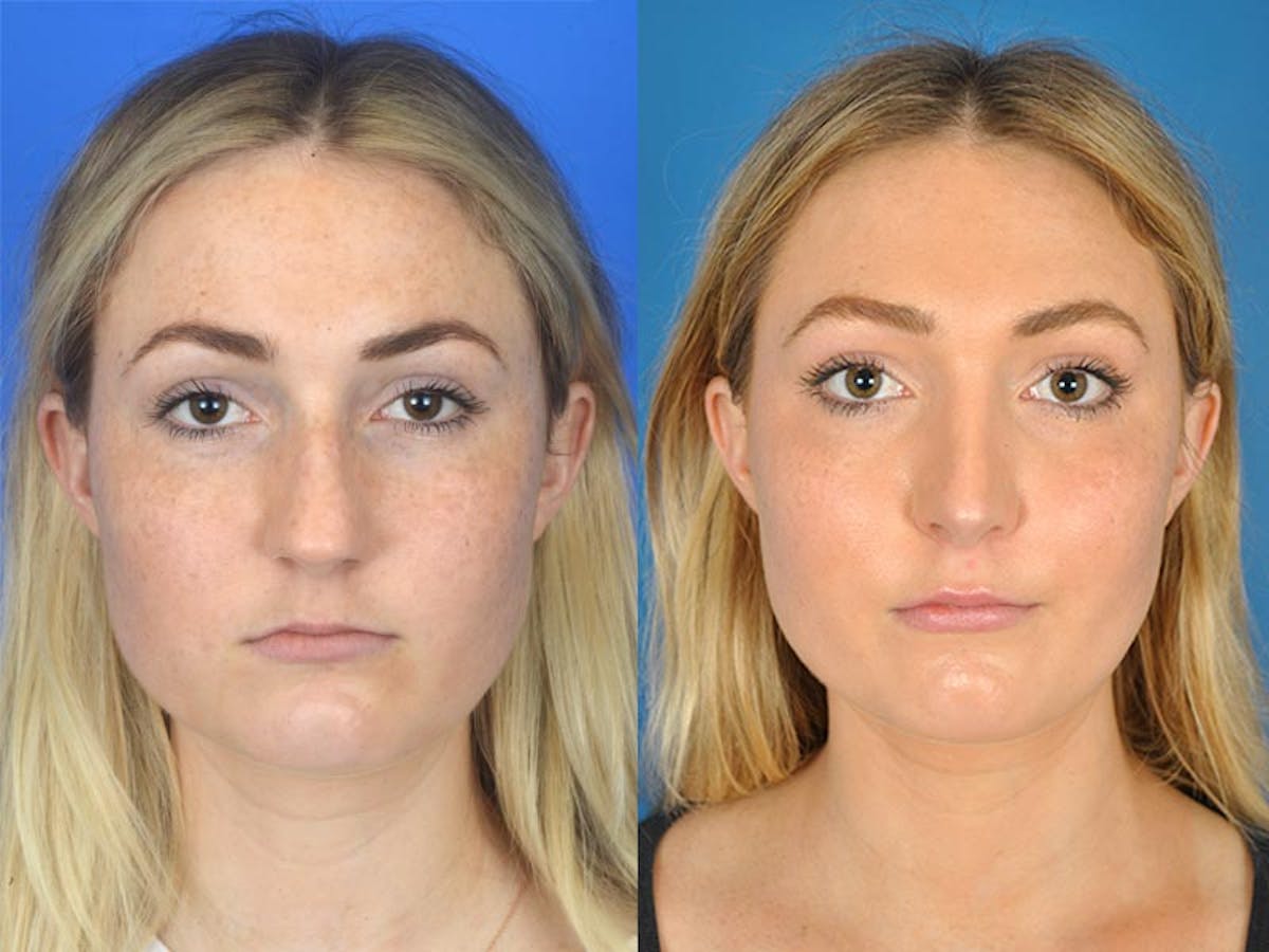 Rhinoplasty Before & After Gallery - Patient 177570483 - Image 2