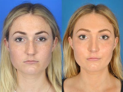 Rhinoplasty Before & After Gallery - Patient 177570483 - Image 1