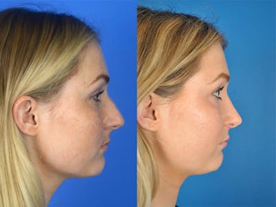 Rhinoplasty Before & After Gallery - Patient 177570483 - Image 1