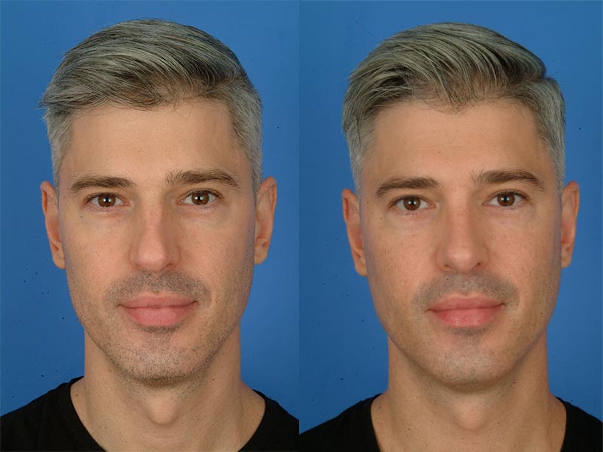 Rhinoplasty Before & After Gallery - Patient 177570488 - Image 2
