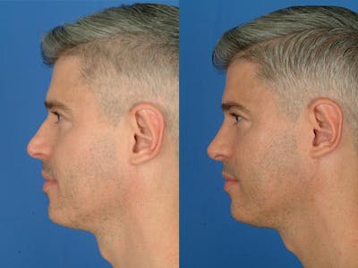 Rhinoplasty Before & After Gallery - Patient 177570488 - Image 1