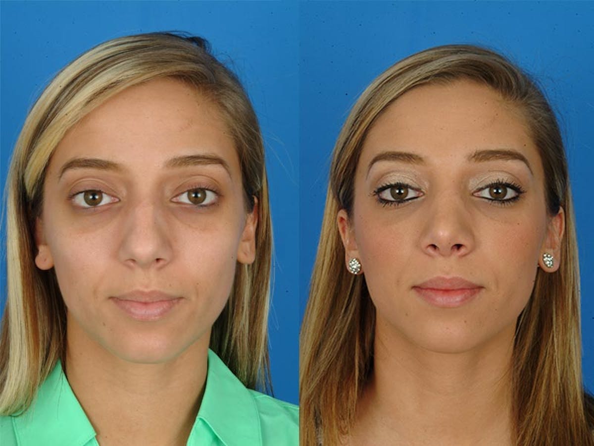 Rhinoplasty Before & After Gallery - Patient 177570493 - Image 2