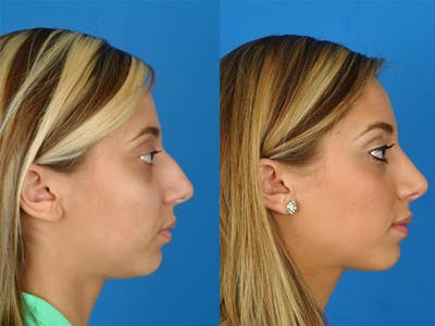 Rhinoplasty Before & After Gallery - Patient 177570493 - Image 1