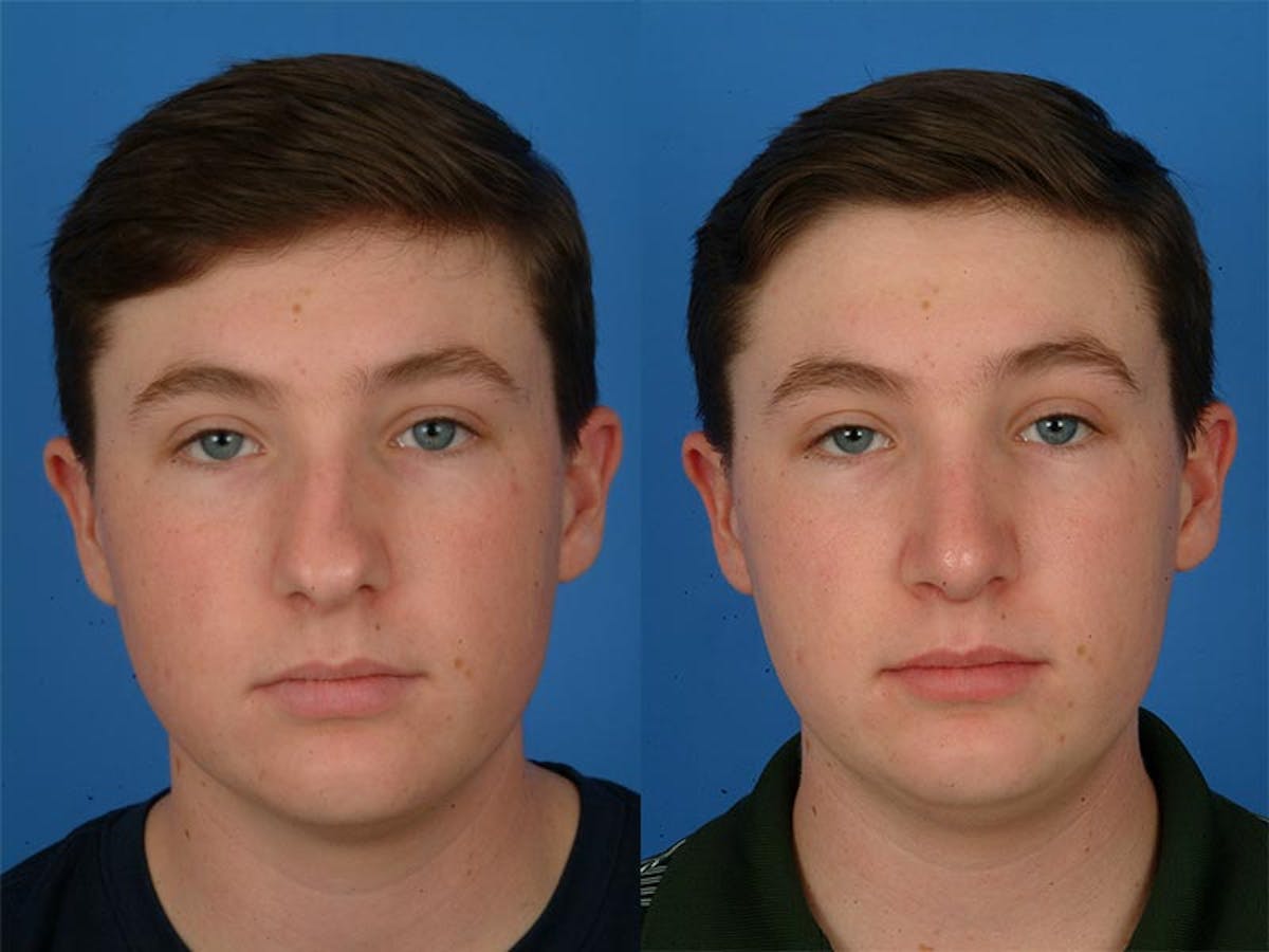 Rhinoplasty Before & After Gallery - Patient 177570511 - Image 1