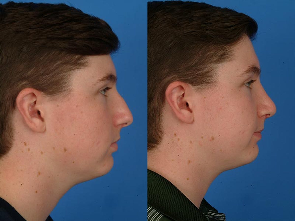 Rhinoplasty Before & After Gallery - Patient 177570511 - Image 2