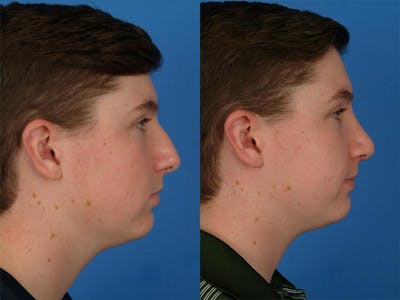 Rhinoplasty Before & After Gallery - Patient 177570511 - Image 1