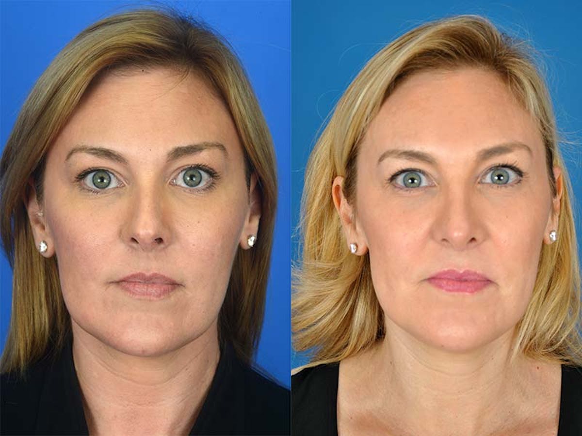 Rhinoplasty Before & After Gallery - Patient 177570512 - Image 2