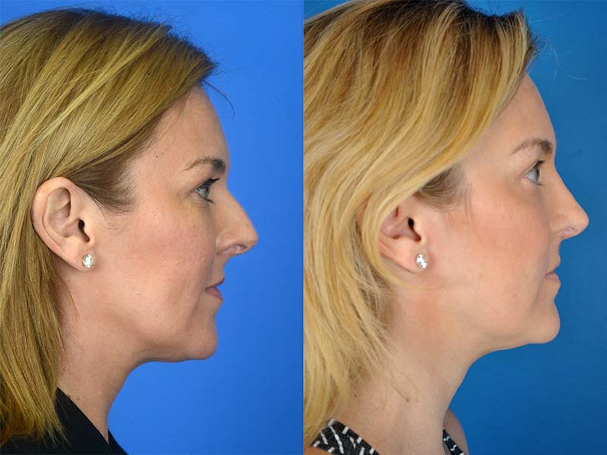 Rhinoplasty Before & After Gallery - Patient 177570512 - Image 1