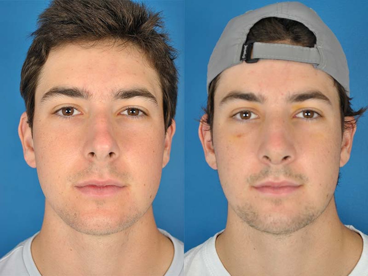 Rhinoplasty Before & After Gallery - Patient 177570513 - Image 2