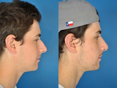 Rhinoplasty Before & After Gallery - Patient 177570513 - Image 1