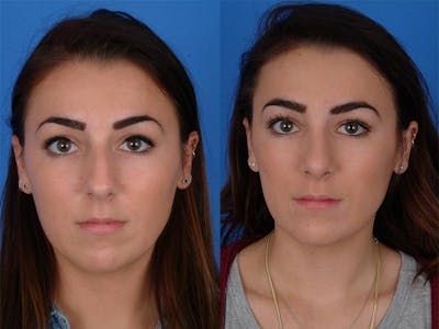 Rhinoplasty Before & After Gallery - Patient 177570514 - Image 1