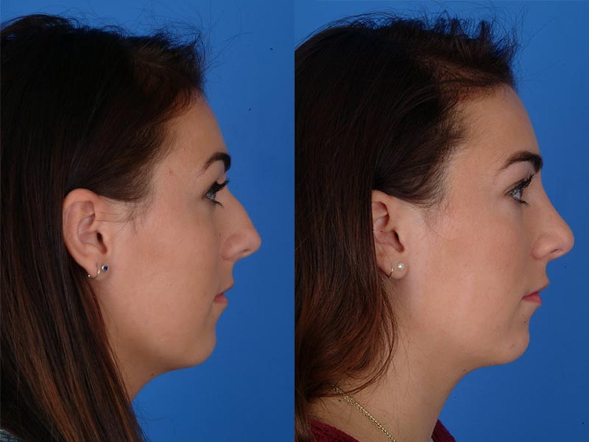 Rhinoplasty Before & After Gallery - Patient 177570514 - Image 2
