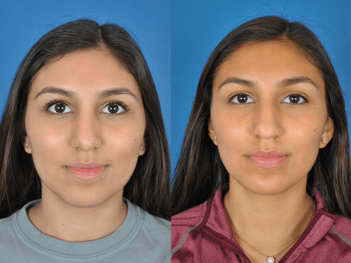 Rhinoplasty Before & After Gallery - Patient 177570517 - Image 2