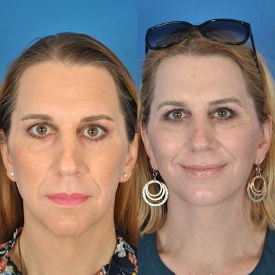 Facelifts Before & After Gallery - Patient 177570518 - Image 1