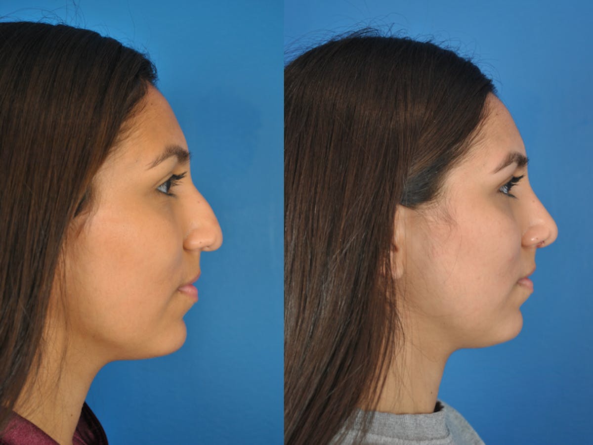 Rhinoplasty Before & After Gallery - Patient 177570517 - Image 2