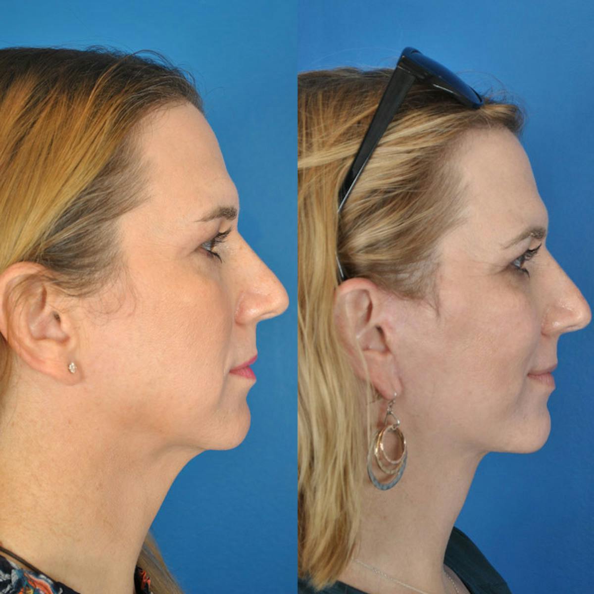 Facelifts Before & After Gallery - Patient 177570518 - Image 2